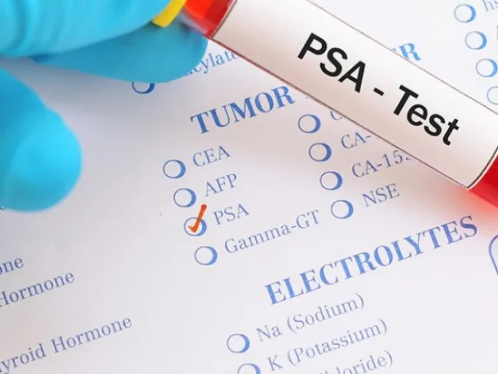 Prostate Cancer Test 03